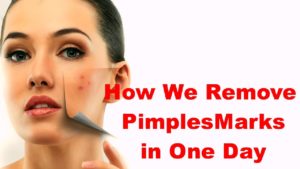 How to Remove Pimple Marks in One Day Home Remedies
